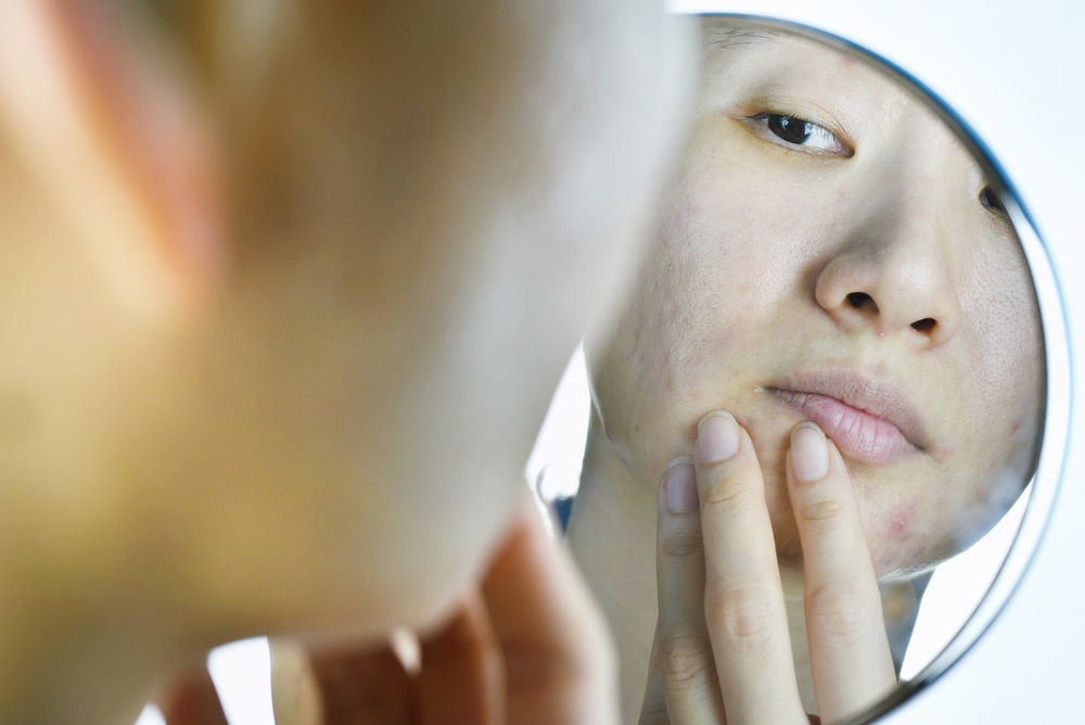 A woman looking at acne scars in the mirror