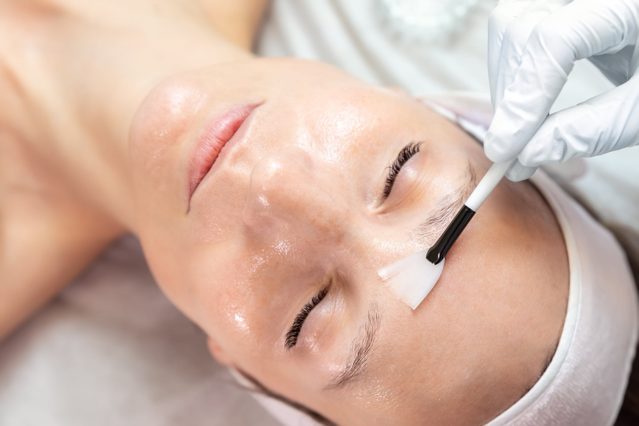 Chemical peel treatment applied to a patients forehead to improve skin texture and tone